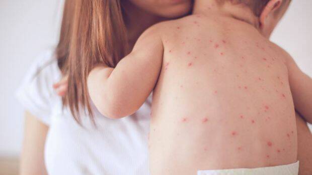 Measles: A case of measles has been reported on the Mid-North Coast.