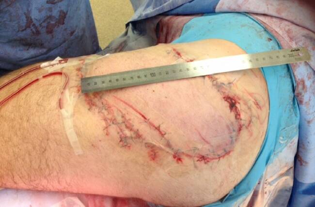 Horrific injury: Dale Carr's leg after being attacked by a white pointer shark. Image supplied.